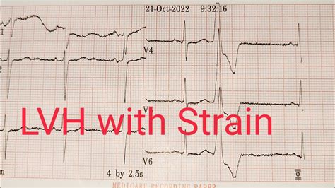 lvh strain|how to assess lv function.